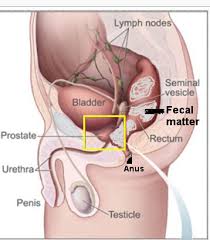 rectum prostate pressure